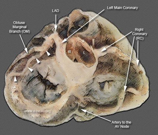 Coronaries and fibrous annulus elderly